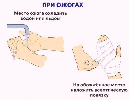 Что нужно сделать в домашних условиях при ожоге