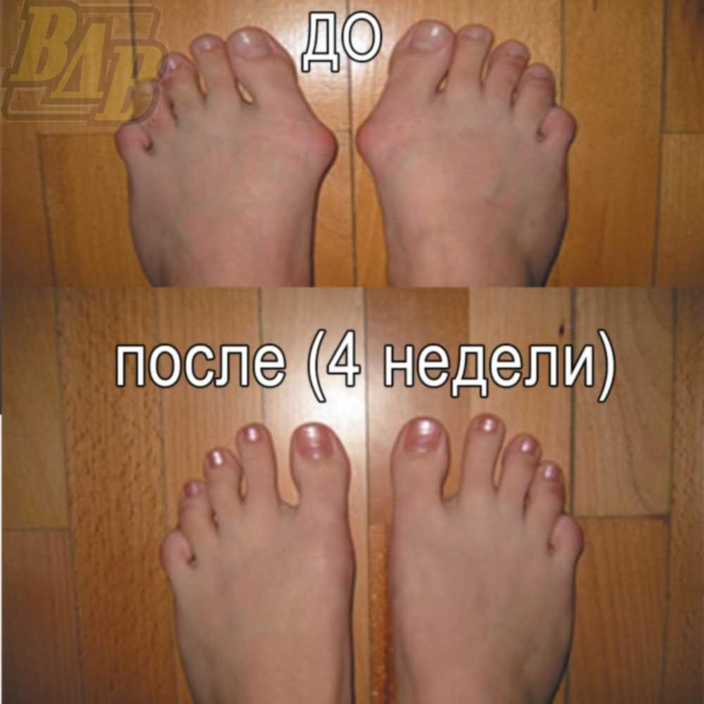 http://static12.insales.ru/files/1/4049/1142737/original/3_valgus_pro_-3.jpg